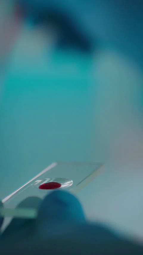 Lab technician examining a blood sample on a microscope slide in a clinical Stock Footage 331602548