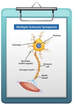 Labeled Diagram of Nerve Cell in Multiple Sclerosis Stock Illustration