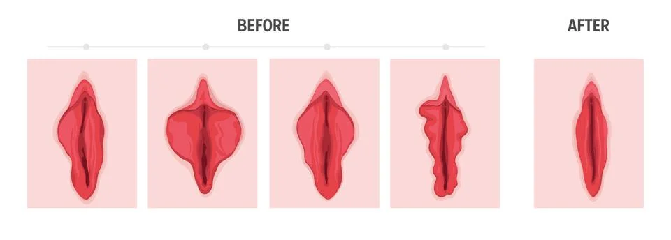 Labiaplasty Stock Illustration