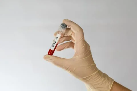 Laboratory sample of blood testing for diagnosis new Corona virus infection Stock Photos