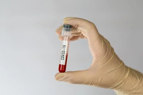 Laboratory sample of blood testing for diagnosis new Corona virus infection Stock Photos