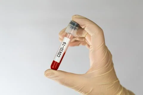 Laboratory sample of blood testing for diagnosis new Corona virus infection Stock Photos