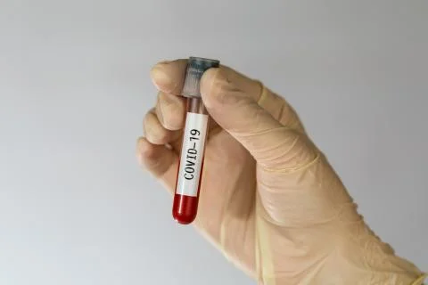 Laboratory sample of blood testing for diagnosis new Corona virus infection Stock Photos