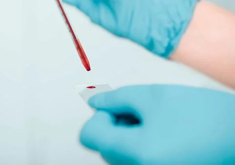 Laboratory scientist applying blood sample on slide, close-up.Blood research Foto stock