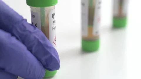 Laboratory technician picking up a stool sample test Stock Footage 336733561