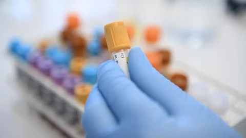 Laboratory technician preparing a HIV sample for testing in the laboratory Stock Footage 129901767