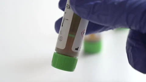 Laboratory worker grabbing stool sample test tube Stock Footage 336733500