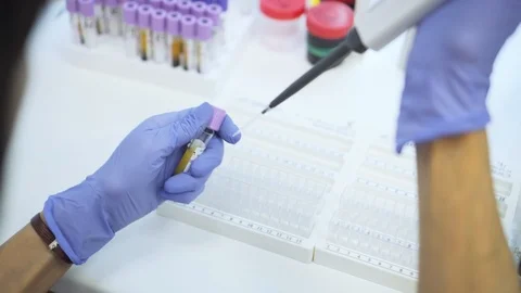 Laboratory worker separate blood samples from test tube in laboratory of clinic Stock Footage 121625434