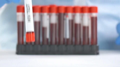 Laboratory worker wearing protective glove puts laboratory tube with HIV test on Stock Footage 126796648