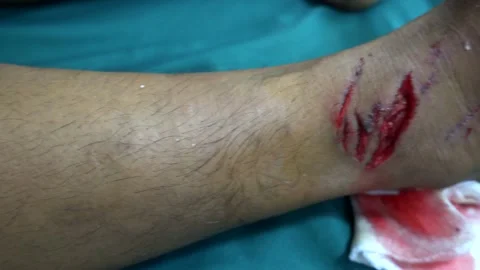 Laceration Right Foot Stock Footage 144425631