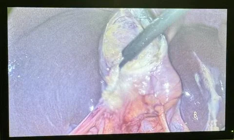 Laparoscopic Gallbladder Surgery In-Progress  1 Stock Photos