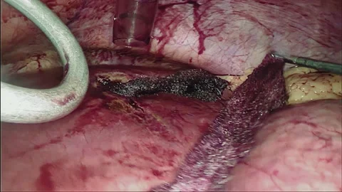 Laparoscopic, Gastrectomy, operation, endoscope 動画素材 236355928