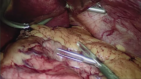 Laparoscopic, Gastrectomy, operation, endoscope Video stock 236355959