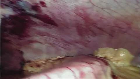 Laparoscopic, Gastrectomy, operation, endoscope Video stock 236355979