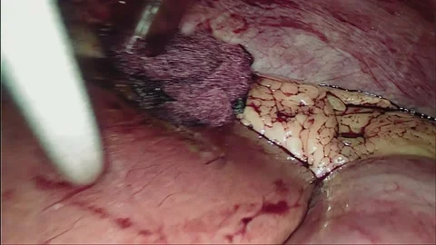 Laparoscopic, Gastrectomy, operation, endoscope Video stock 236355980