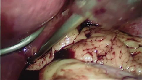 Laparoscopic, Gastrectomy, operation, endoscope Video stock 236356033