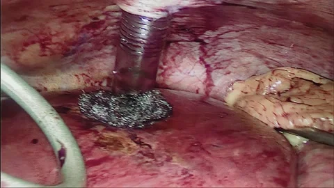 Laparoscopic, Gastrectomy, operation, endoscope Video stock 236356540