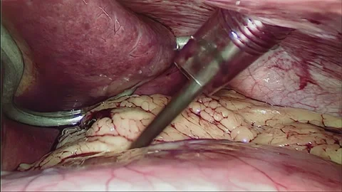 Laparoscopic, Gastrectomy, operation, endoscope Video stock 236356596