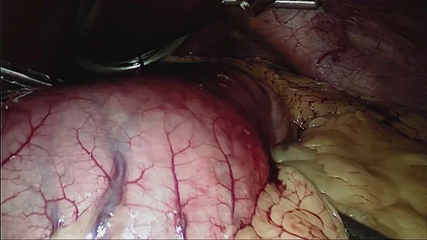 Laparoscopic, Gastrectomy, operation, endoscope Video stock 236356622