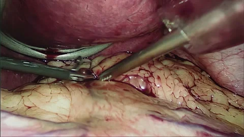 Laparoscopic, Gastrectomy, operation, endoscope Video stock 236356641