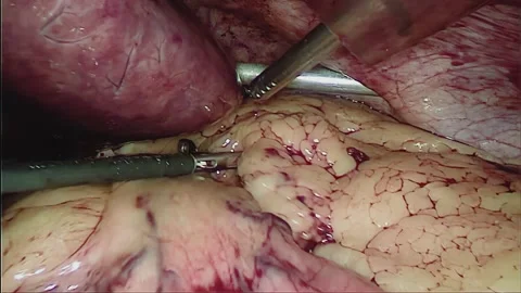 Laparoscopic, Gastrectomy, operation, endoscope Video stock 236357117