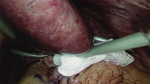 Laparoscopic, Gastrectomy, operation, endoscope Video stock 236357222