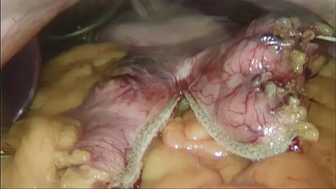 Laparoscopic, Gastrectomy, operation, endoscope Video stock 236357233
