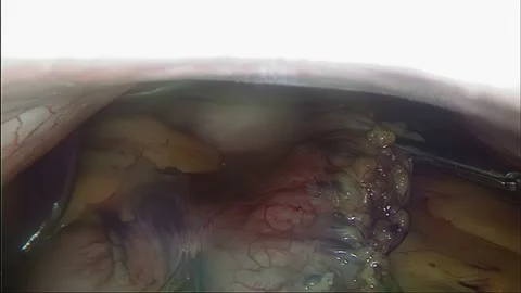 Laparoscopic, Gastrectomy, operation, endoscope Video stock 236357261