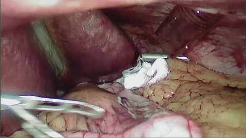 Laparoscopic, Gastrectomy, operation, endoscope Video stock 236357297