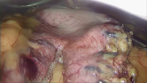 Laparoscopic, Gastrectomy, operation, endoscope Video stock 236357844