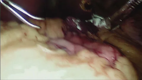 Laparoscopic, Gastrectomy, operation, endoscope Video stock 236357868