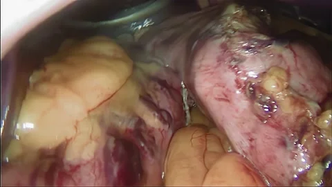Laparoscopic, Gastrectomy, operation, endoscope Video stock 236357912