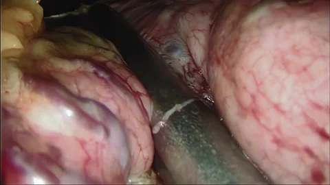 Laparoscopic, Gastrectomy, operation, endoscope Video stock 236357920
