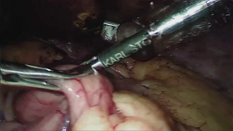 Laparoscopic, Gastrectomy, operation, endoscope Video stock 236357924