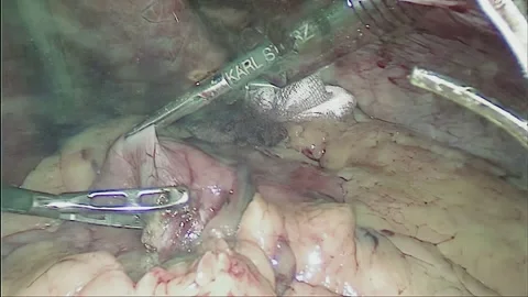 Laparoscopic, Gastrectomy, operation, endoscope Video stock 236358566