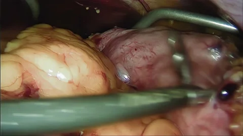 Laparoscopic, Gastrectomy, operation, endoscope Video stock 236358577