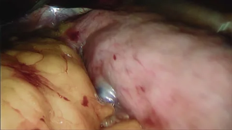 Laparoscopic, Gastrectomy, operation, endoscope Video stock 236358646