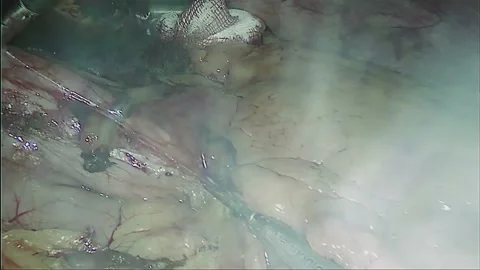 Laparoscopic, Gastrectomy, operation, endoscope Video stock 236358774