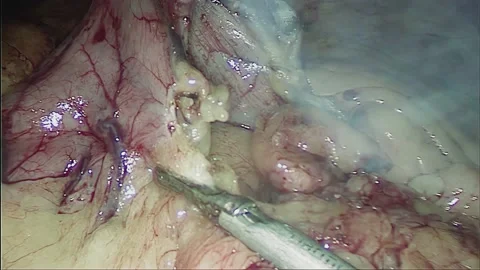 Laparoscopic, Gastrectomy, operation, endoscope Video stock 236358784