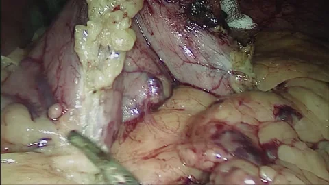 Laparoscopic, Gastrectomy, operation, endoscope Video stock 236359375