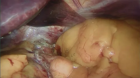 Laparoscopic, Gastrectomy, operation, endoscope Video stock 236359703