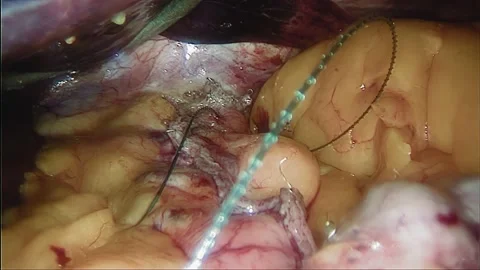 Laparoscopic, Gastrectomy, operation, endoscope Video stock 236359715