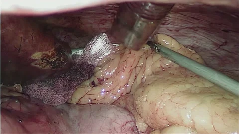 Laparoscopic, Gastrectomy, operation, endoscope Video stock 236359727