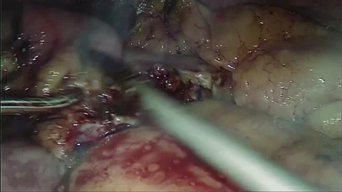 Laparoscopic, Gastrectomy, operation, endoscope Video stock 236359736