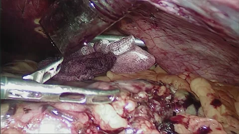 Laparoscopic, Gastrectomy, operation, endoscope Video stock 236360157