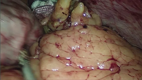 Laparoscopic, Gastrectomy, operation, endoscope Video stock 236360334