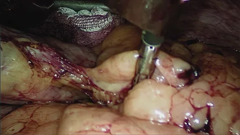 Laparoscopic, Gastrectomy, operation, endoscope Video stock 236360351