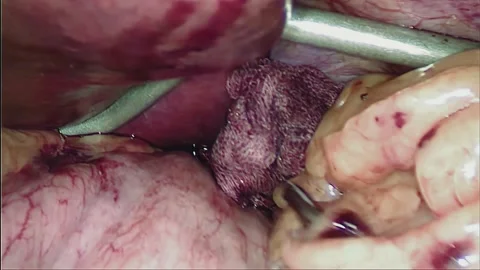 Laparoscopic, Gastrectomy, operation, endoscope Video stock 236360353