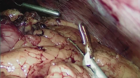 Laparoscopic, Gastrectomy, operation, endoscope Video stock 236360379