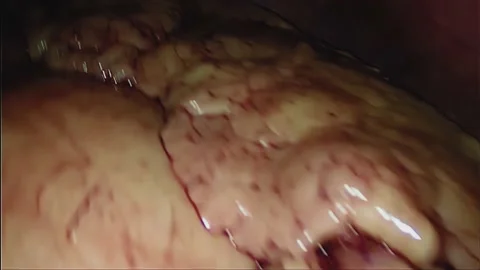 Laparoscopic, Gastrectomy, operation, endoscope Video stock 236360735